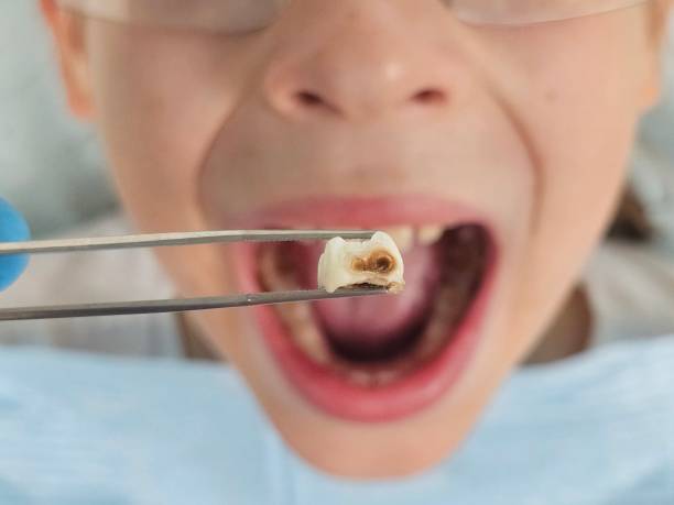 Best Emergency Dentist for Knocked-Out Tooth in Shoh, IL